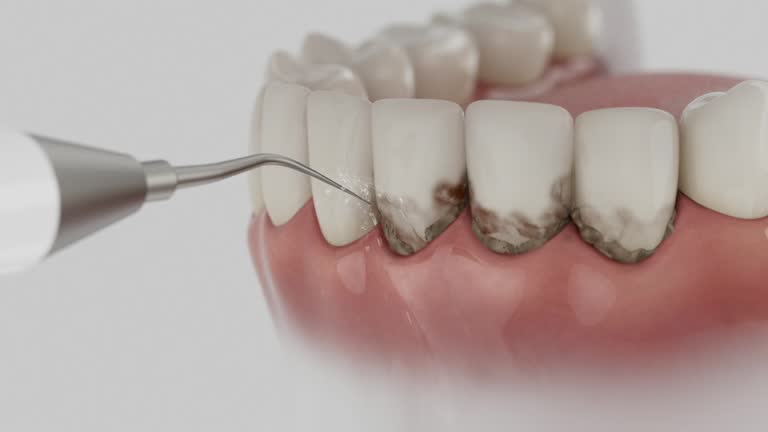 Trusted Dental Crowns And Bridges service in Aberdeen, MD - Dentist Open Now
